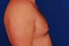 Gynecomastia Surgery Before & After Image