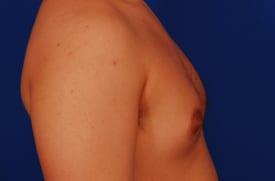 Gynecomastia Surgery Before & After Image