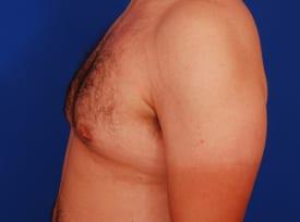 Gynecomastia Surgery Before & After Image
