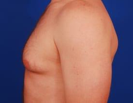 Gynecomastia Surgery Before & After Image