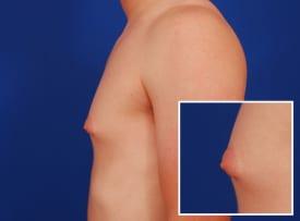 Gynecomastia Surgery Before & After Image