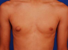 Gynecomastia Surgery Before & After Image