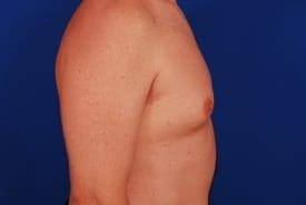 Gynecomastia Surgery Before & After Image