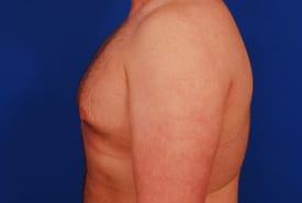 Gynecomastia Surgery Before & After Image