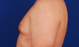 Gynecomastia Surgery Before & After Image