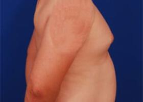 Gynecomastia Surgery Before & After Image