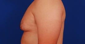 Gynecomastia Surgery Before & After Image