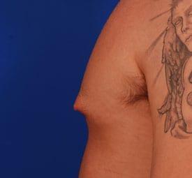 Gynecomastia Surgery Before & After Image