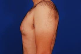 Gynecomastia Surgery Before & After Image