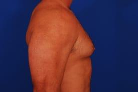 Gynecomastia Surgery Before & After Image