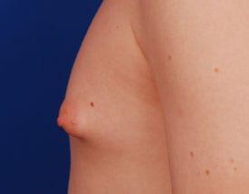 Gynecomastia Surgery Before & After Image