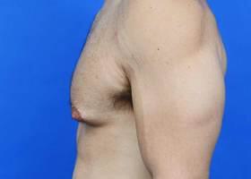 Revision Gynecomastia Surgery Before & After Image