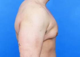 Revision Gynecomastia Surgery Before & After Image