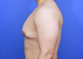 Revision Gynecomastia Surgery Before & After Image