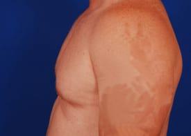 Revision Gynecomastia Surgery Before & After Image