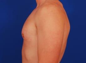 Revision Gynecomastia Surgery Before & After Image