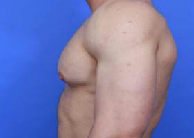 Austin Gynecomastia Surgery Before