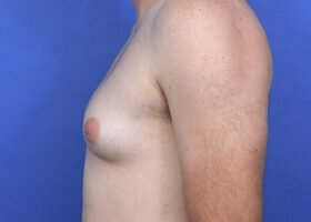 Austin Gynecomastia Surgery patient Before