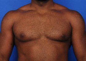 Austin Gynecomastia Surgery patient Before