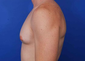 Austin Gynecomastia Surgery patient Before