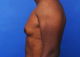 Austin Gynecomastia Surgery patient Before