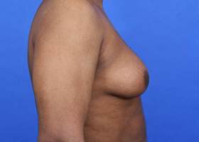 Austin Gynecomastia Surgery patient Before 