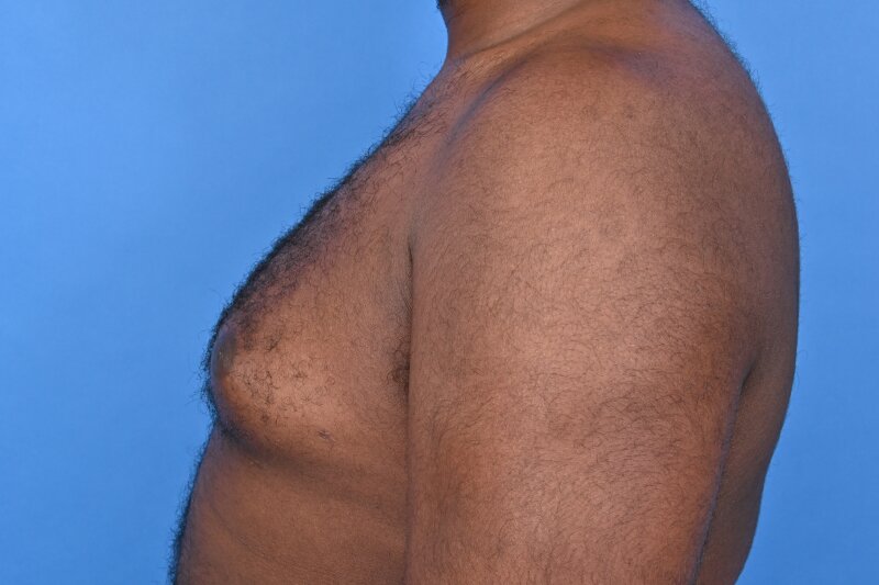 Gynecomastia Surgery Before & After Image