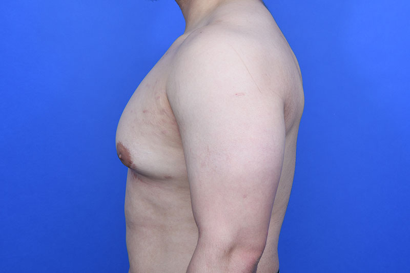 Gynecomastia Surgery Before & After Image