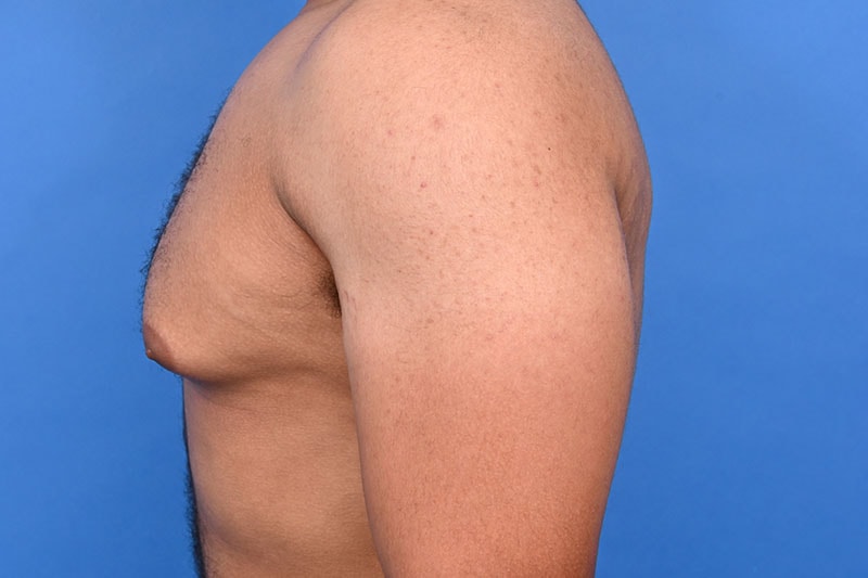 Gynecomastia Surgery Before & After Image