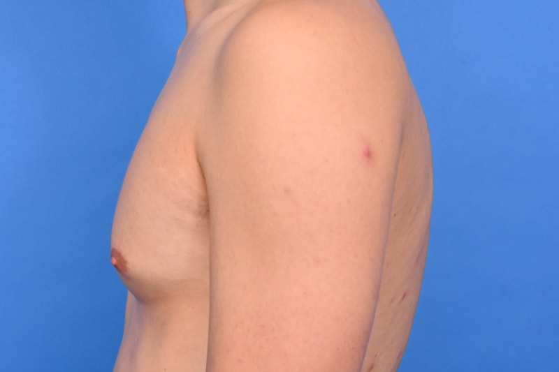 Gynecomastia Surgery Before & After Image