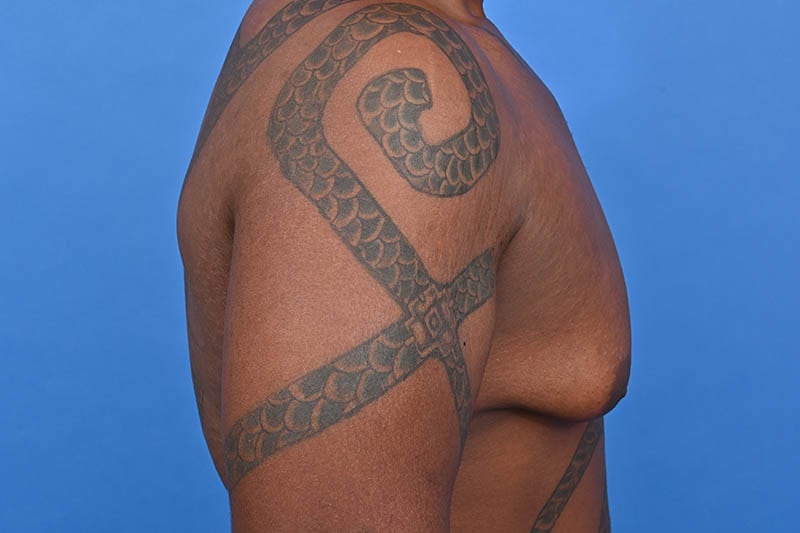 Gynecomastia Surgery Before & After Image