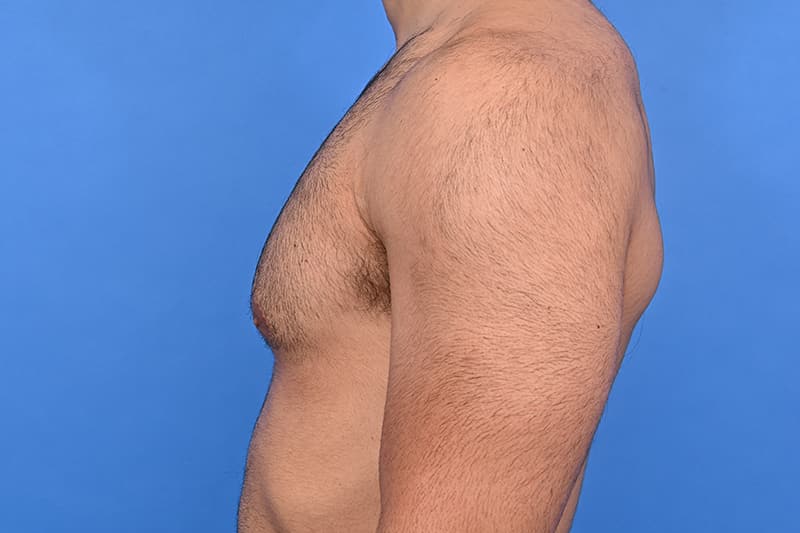 Gynecomastia Surgery Before & After Image