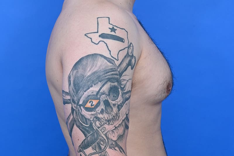 Gynecomastia Surgery Before & After Image