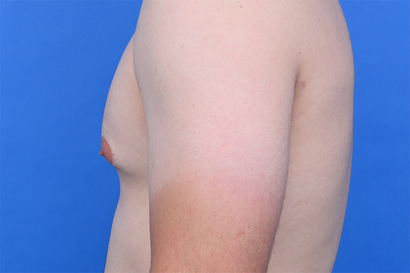Gynecomastia Surgery Before & After Image