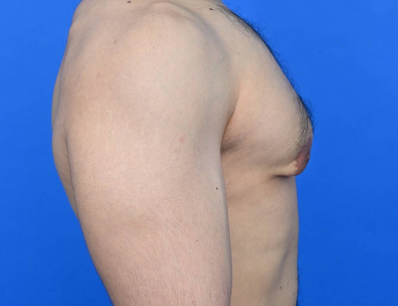 Gynecomastia Surgery Before & After Image