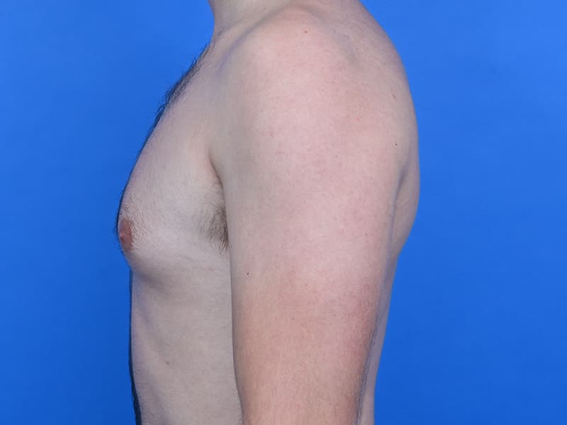 Gynecomastia Surgery Before & After Image