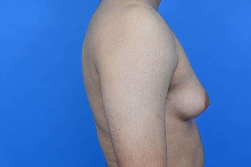 Gynecomastia Surgery Before & After Image