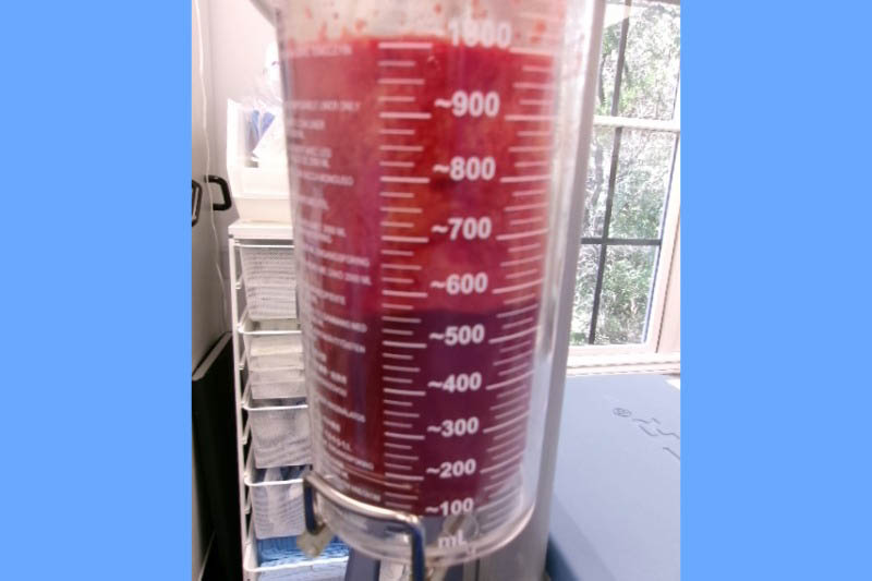 Gynecomastia Surgery Before & After Image