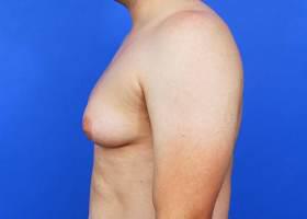 Gynecomastia Surgery Before & After Image