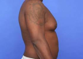 Gynecomastia Surgery Before & After Image