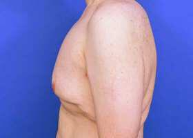 Gynecomastia Surgery Before & After Image