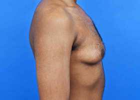 Gynecomastia Surgery Before & After Image