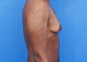 Gynecomastia Surgery Before & After Image