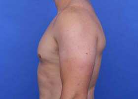 Gynecomastia Surgery Before & After Image