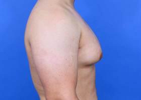 Gynecomastia Surgery Before & After Image
