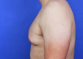 Gynecomastia Surgery Before & After Image
