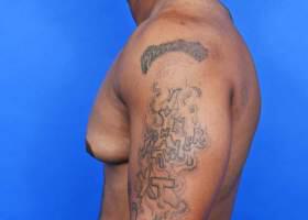 Gynecomastia Surgery Before & After Image