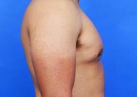 Gynecomastia Surgery Before & After Image