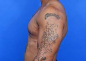Gynecomastia Surgery Before & After Image