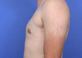 Gynecomastia Surgery Before & After Image